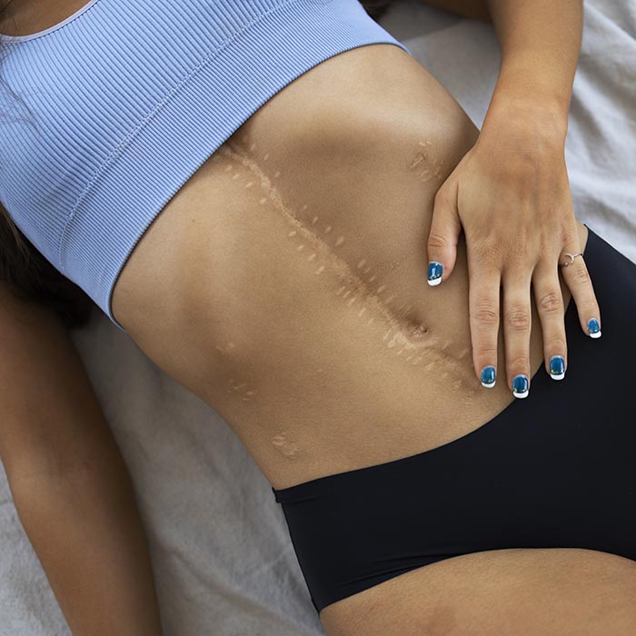 Scar Treatments Clinic in Mississauga, ON: Scar Removal Near You