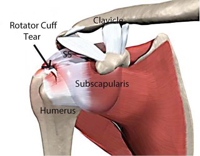 Effective Relief: Address Rotator Cuff Pain in Houston