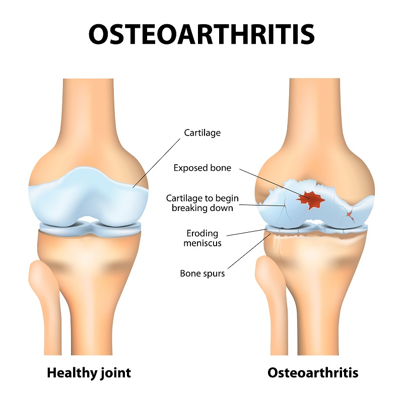 Weather and Joint Pain - Houston Spine & Joint Pain Consultants