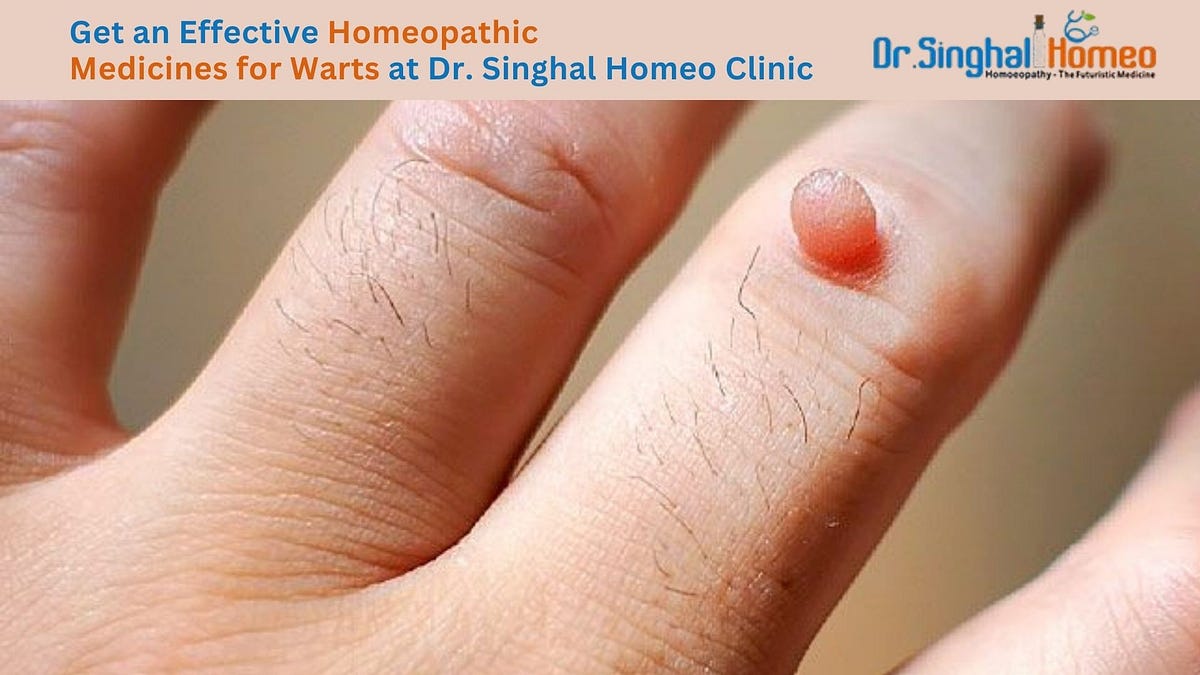 Warts Homeopathy Medicine: Natural Solutions for Skin Growths | by Dr. Singhal Homeo | Dec, 2024 | Medium